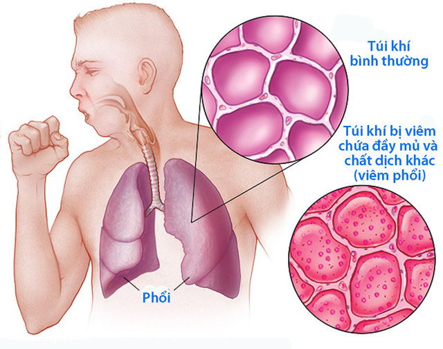 Viêm phổi cấp